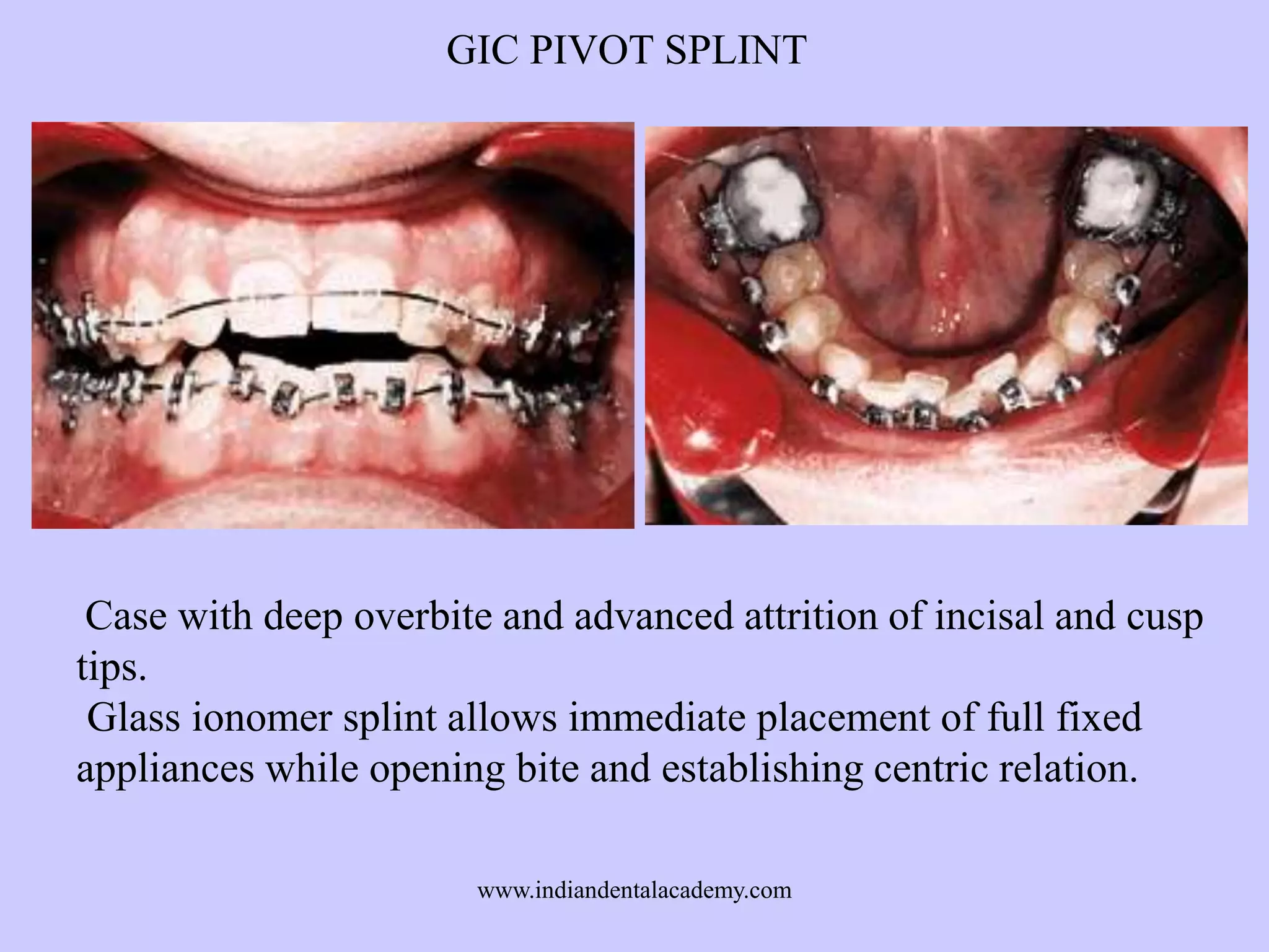 GIC PIVOT SPLINT

Case with deep overbite and advanced attrition of incisal and cusp
tips.
Glass ionomer splint allows immediate placement of full fixed
appliances while opening bite and establishing centric relation.
www.indiandentalacademy.com

 