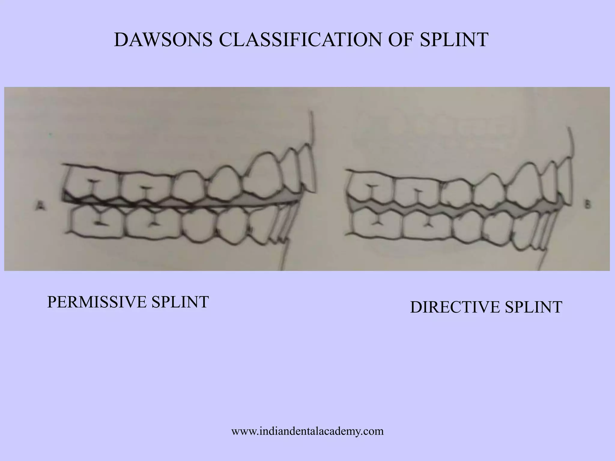 DAWSONS CLASSIFICATION OF SPLINT

PERMISSIVE SPLINT

DIRECTIVE SPLINT

www.indiandentalacademy.com

 