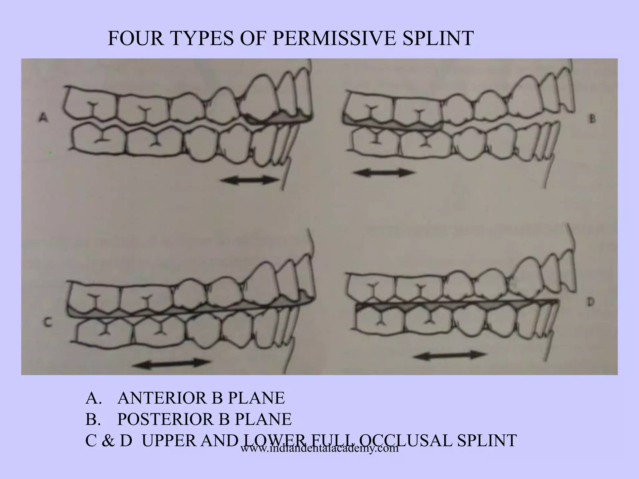 FOUR TYPES OF PERMISSIVE SPLINT

A. ANTERIOR B PLANE
B. POSTERIOR B PLANE
C & D UPPER AND www.indiandentalacademy.com
LOWER FULL OCCLUSAL SPLINT

 