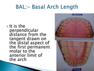  It is the
perpendicular
distance from the
tangent drawn on
the distal aspect of
the first permanent
molar to the
anterior limit of
the arch
 