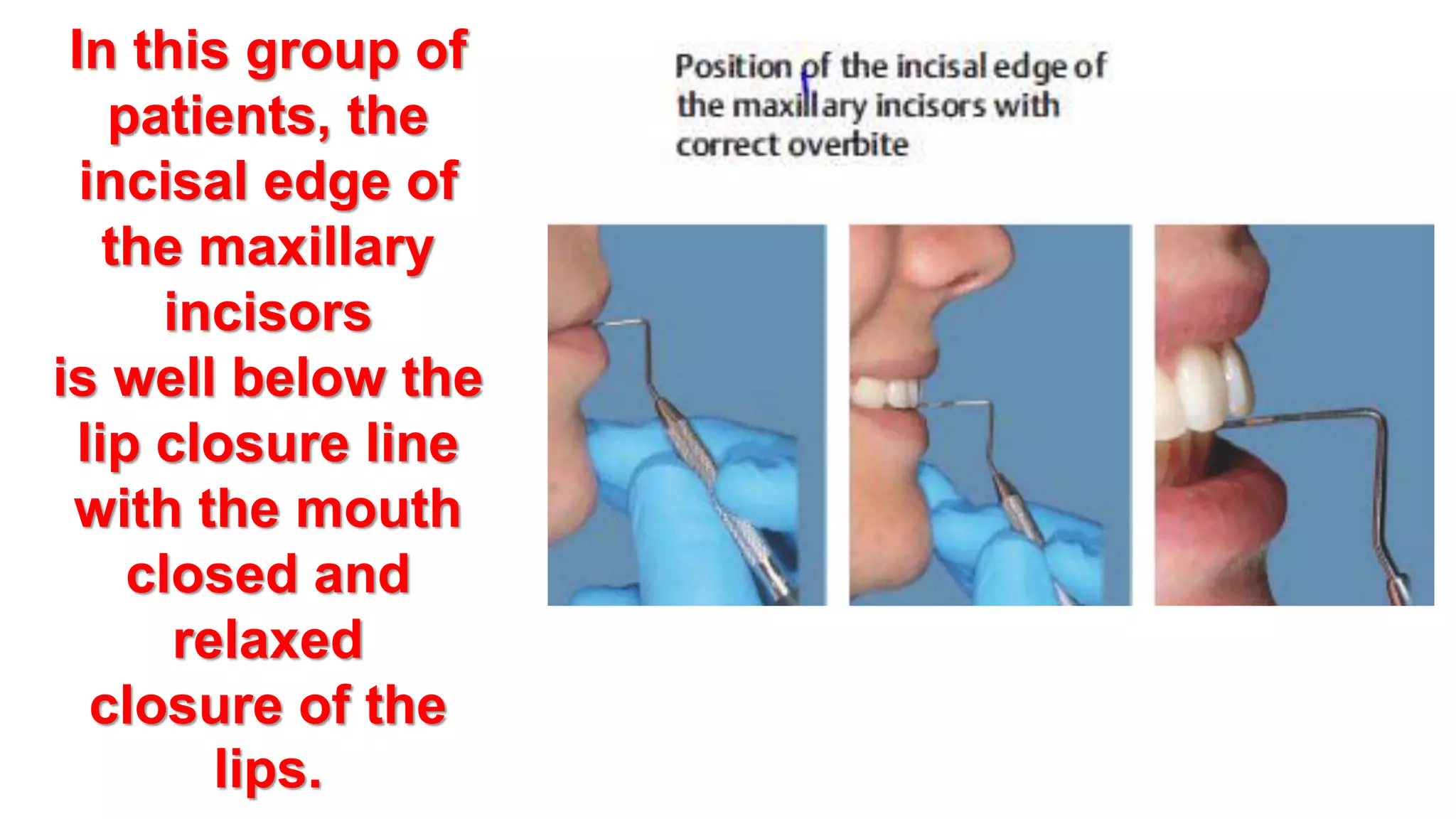 Orthodontic treatment of deep bite part 1 | PPTX