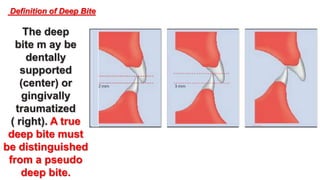 Orthodontic treatment of deep bite part 1 | PPTX