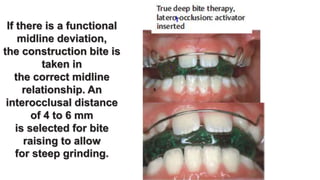 Orthodontic treatment of deep bite part 2 | PPTX
