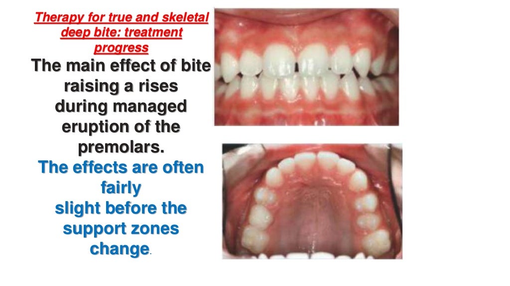 Orthodontic treatment of deep bite part 2