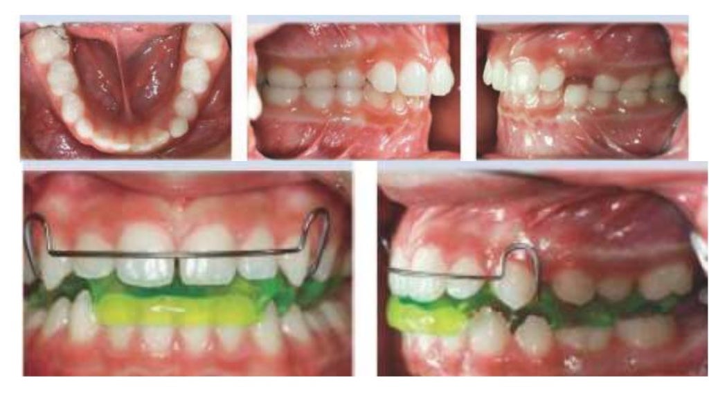 Orthodontic treatment of deep bite part 2