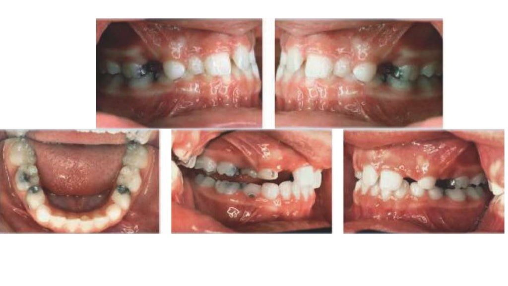 Orthodontic treatment of deep bite part 2