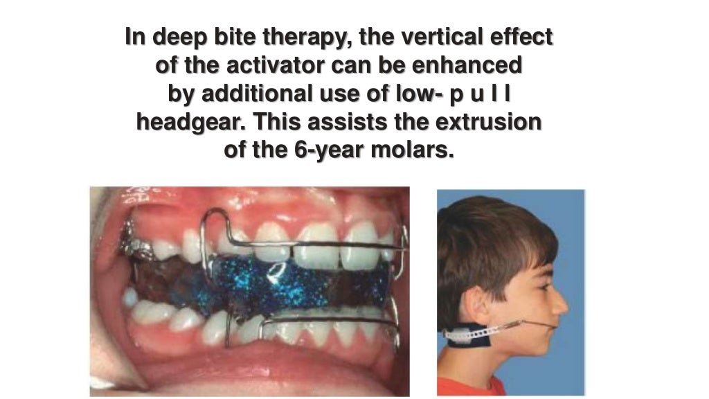 Orthodontic treatment of deep bite part 2