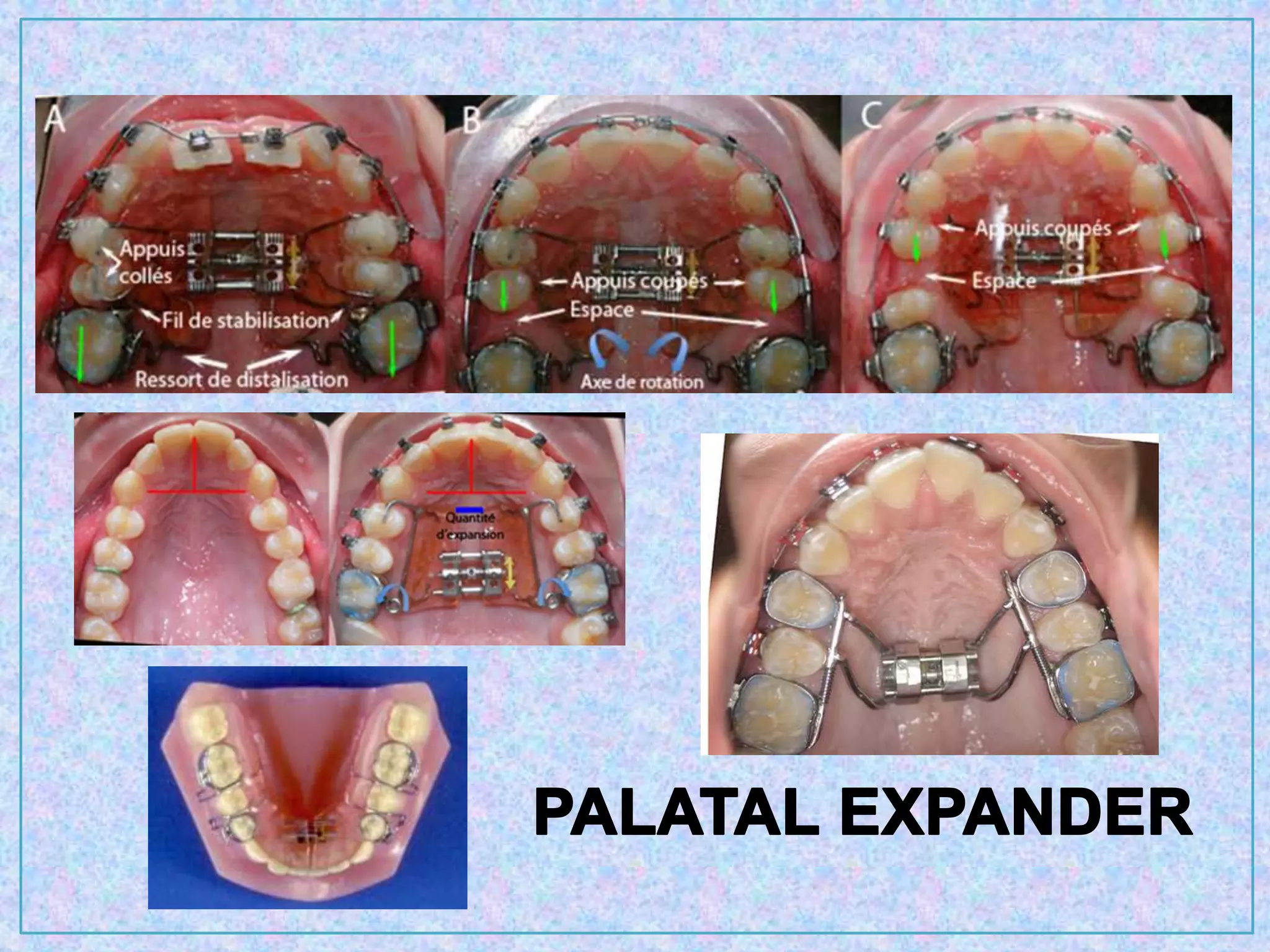 Orthodontic treatment planning