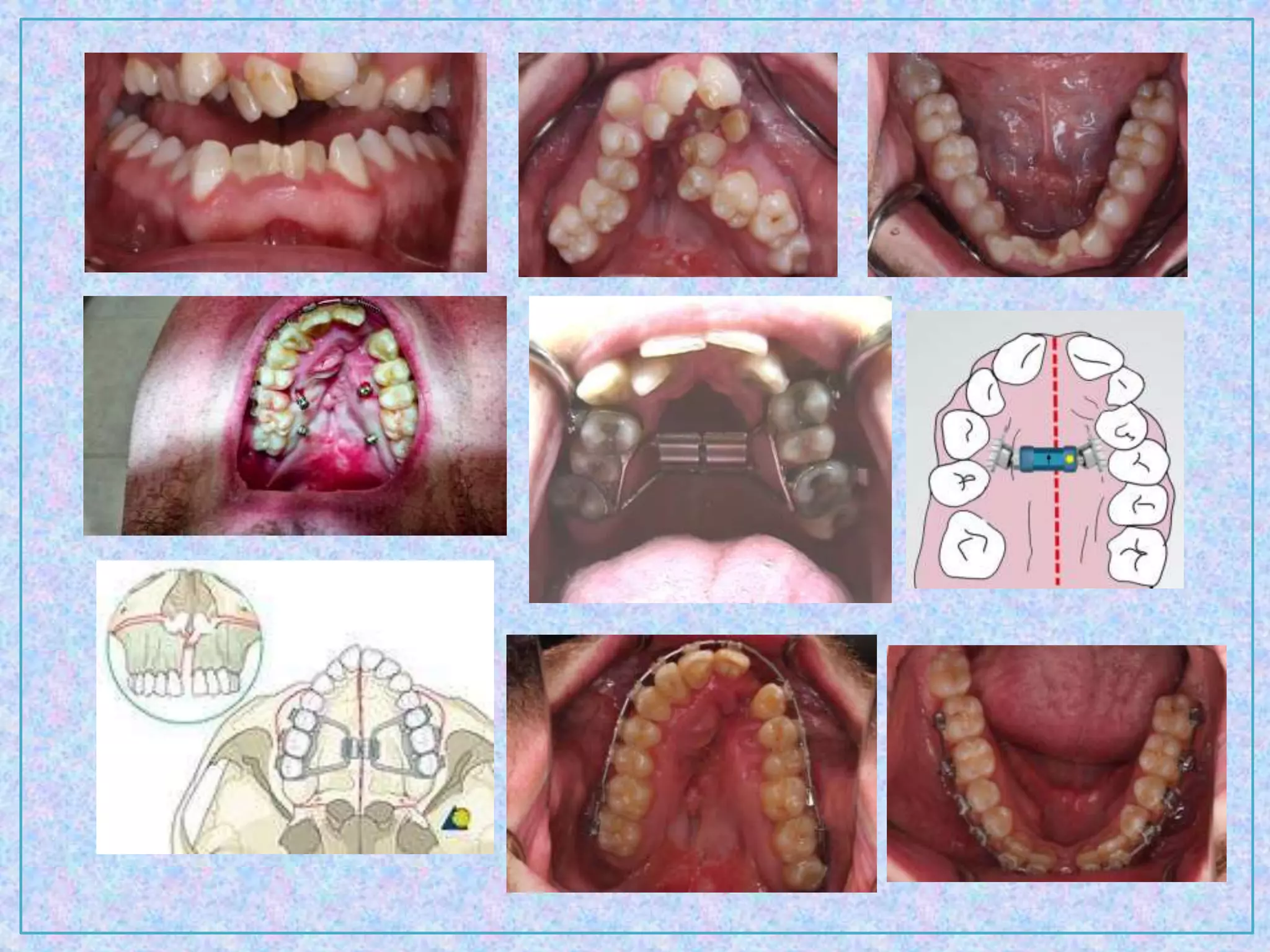 Orthodontic treatment planning