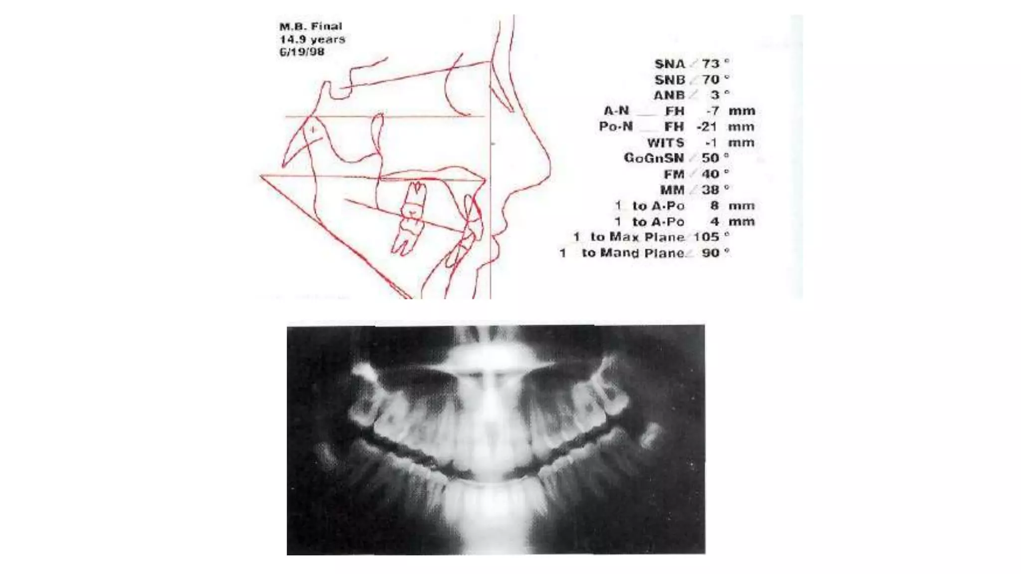 MBT wire sequence during orthodontic alignment and leveling | PPTX