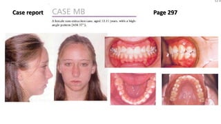 MBT wire sequence during orthodontic alignment and leveling | PPTX