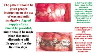 MBT wire sequence during orthodontic alignment and leveling | PPTX