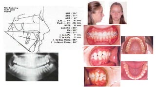 MBT wire sequence during orthodontic alignment and leveling | PPTX