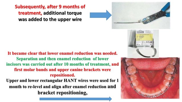 MBT wire sequence during orthodontic alignment and leveling | PPTX ...