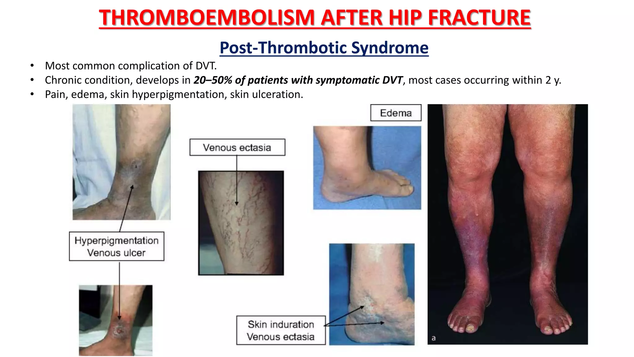 THROMBOEMBOLISM AFTER HIP FRACTURE
Post-Thrombotic Syndrome
• Most common complication of DVT.
• Chronic condition, develops in 20–50% of patients with symptomatic DVT, most cases occurring within 2 y.
• Pain, edema, skin hyperpigmentation, skin ulceration.
 