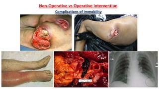Non-Operative vs Operative Intervention
Complications of Immobility
 