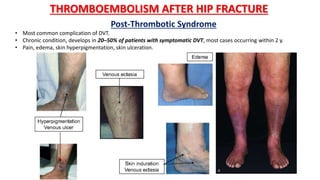 THROMBOEMBOLISM AFTER HIP FRACTURE
Post-Thrombotic Syndrome
• Most common complication of DVT.
• Chronic condition, develops in 20–50% of patients with symptomatic DVT, most cases occurring within 2 y.
• Pain, edema, skin hyperpigmentation, skin ulceration.
 