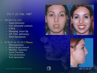CH, F, 23. Feb. 1997 PROBLEM LIST Nasal deformity Full inframalar contours V.M.E. Drooping  lower lip  AP  Chin  deficiency Neck lipomatosis SURGICAL PLAN  2 Phases Rhinoseptoplasty  Buccal fat pad removal  Maxillary  impaction Lower Lip plasty Chin advancement Neck liposuction 