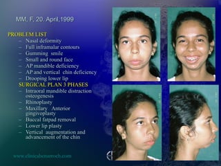 MM, F, 20. April,1999 PROBLEM LIST Nasal deformity Full inframalar contours Gumming  smile Small and round face  AP mandible deficiency AP and vertical  chin deficiency Drooping lower lip  SURGICAL PLAN 3 PHASES Intraoral mandible distraction osteogenesis Rhinoplasty Maxillary  Anterior gingivoplasty  Buccal fatpad removal Lower lip plasty Vertical  augmentation and advancement of the chin  