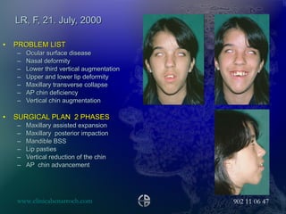 LR, F, 21. July, 2000 PROBLEM LIST Ocular surface disease Nasal deformity Lower third vertical augmentation Upper and lower lip deformity Maxillary transverse collapse AP chin deficiency Vertical chin augmentation SURGICAL PLAN  2 PHASES Maxillary assisted expansion Maxillary  posterior impaction Mandible BSS Lip pasties Vertical reduction of the chin AP  chin advancement  