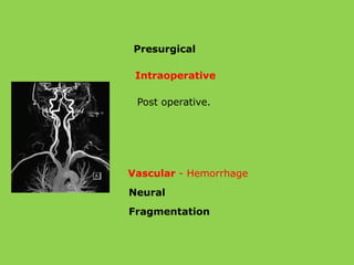 Presurgical
Intraoperative
Post operative.
Vascular - Hemorrhage
Neural
Fragmentation
 