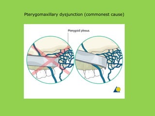 Pterygomaxillary dysjunction (commonest cause)
 