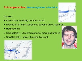 Causes:
• Retraction medially behind ramus
• Extension of distal segment beyond prox. segment
• Haematoma
• Genioplasty : direct trauma to marginal branch
• Sagittal split : direct trauma to trunk
Intraoperative: Nerve injuries –Facial N.
 