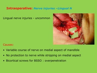 Lingual nerve injuries - uncommon
Causes:
• Variable course of nerve on medial aspect of mandible
• No protection to nerve while stripping on medial aspect
• Bicortical screws for BSSO : overpenetration
Intraoperative: Nerve injuries –Lingual N
 