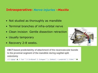 • Not studied as thoroughly as mandible
• Terminal branches of infra-orbital nerve
• Clean incision Gentle dissection retraction
• Usually temporary
• Recovery 2-8 weeks.
Intraoperative: Nerve injuries –Maxilla
 