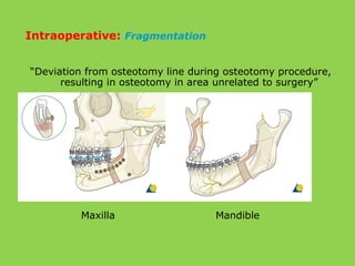 “Deviation from osteotomy line during osteotomy procedure,
resulting in osteotomy in area unrelated to surgery”
Maxilla Mandible
Intraoperative: Fragmentation
 