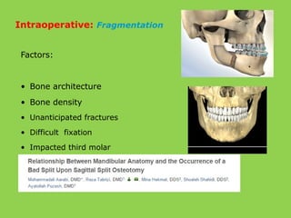 Factors:
• Bone architecture
• Bone density
• Unanticipated fractures
• Difficult fixation
• Impacted third molar
Intraoperative: Fragmentation
 