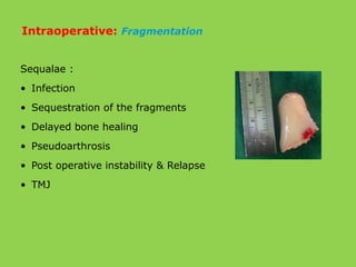 Sequalae :
• Infection
• Sequestration of the fragments
• Delayed bone healing
• Pseudoarthrosis
• Post operative instability & Relapse
• TMJ
Intraoperative: Fragmentation
 