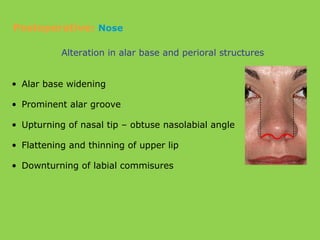 Alteration in alar base and perioral structures
• Alar base widening
• Prominent alar groove
• Upturning of nasal tip – obtuse nasolabial angle
• Flattening and thinning of upper lip
• Downturning of labial commisures
Postoperative: Nose
 