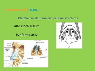 Alar cinch suture
Pyriformplasty
Alteration in alar base and perioral structures
Postoperative: Nose
 