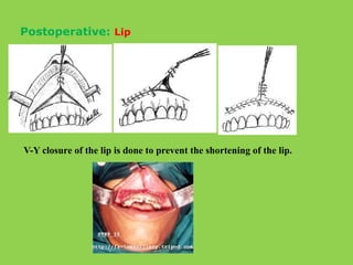 Postoperative: Lip
V-Y closure of the lip is done to prevent the shortening of the lip.
 