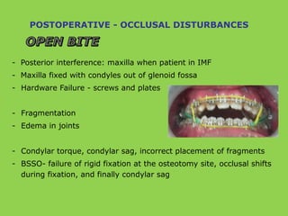 POSTOPERATIVE - OCCLUSAL DISTURBANCES
- Posterior interference: maxilla when patient in IMF
- Maxilla fixed with condyles out of glenoid fossa
- Hardware Failure - screws and plates
- Fragmentation
- Edema in joints
- Condylar torque, condylar sag, incorrect placement of fragments
- BSSO- failure of rigid fixation at the osteotomy site, occlusal shifts
during fixation, and finally condylar sag
 