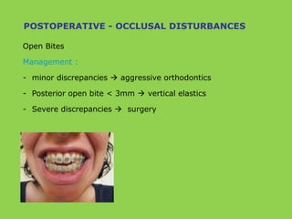 Open Bites
Management :
- minor discrepancies  aggressive orthodontics
- Posterior open bite < 3mm  vertical elastics
- Severe discrepancies  surgery
POSTOPERATIVE - OCCLUSAL DISTURBANCES
 