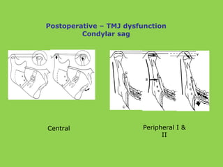 Postoperative – TMJ dysfunction
Condylar sag
Central Peripheral I &
II
 