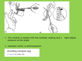 • The condyle is seated with the condylar seating tool + light digital
pressure at the angle
• resultant vector is anterosuperior
 