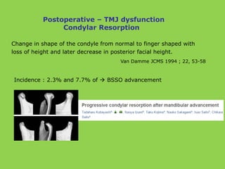Change in shape of the condyle from normal to finger shaped with
loss of height and later decrease in posterior facial height.
Van Damme JCMS 1994 ; 22, 53-58
Incidence : 2.3% and 7.7% of  BSSO advancement
Postoperative – TMJ dysfunction
Condylar Resorption
 