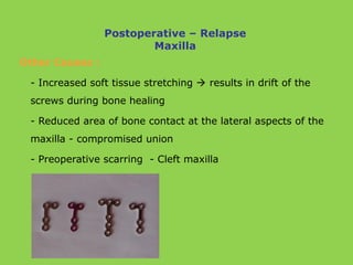 Other Causes :
- Increased soft tissue stretching  results in drift of the
screws during bone healing
- Reduced area of bone contact at the lateral aspects of the
maxilla - compromised union
- Preoperative scarring - Cleft maxilla
Postoperative – Relapse
Maxilla
 