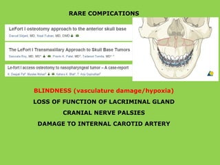 RARE COMPICATIONS
BLINDNESS (vasculature damage/hypoxia)
LOSS OF FUNCTION OF LACRIMINAL GLAND
CRANIAL NERVE PALSIES
DAMAGE TO INTERNAL CAROTID ARTERY
 