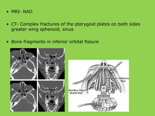 • MRI- NAD
• CT- Complex fractures of the pterygoid plates on both sides
greater wing sphenoid, sinus
• Bone fragments in inferior orbital fissure
 