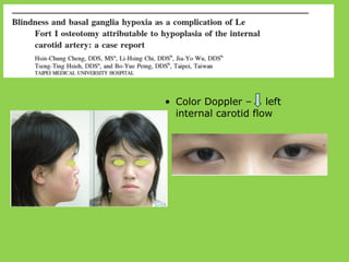 • Color Doppler – left
internal carotid flow
 