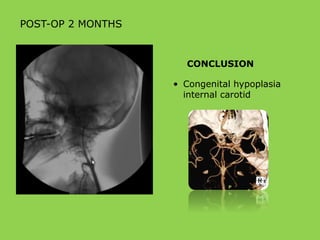 POST-OP 2 MONTHS
CONCLUSION
• Congenital hypoplasia
internal carotid
 