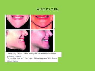 WITCH’S CHIN
 