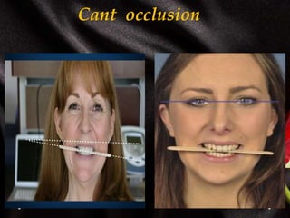Cant occlusion
 