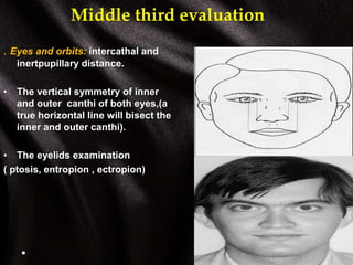 Middle third evaluation
. Eyes and orbits: intercathal and
inertpupillary distance.
• The vertical symmetry of inner
and outer canthi of both eyes,(a
true horizontal line will bisect the
inner and outer canthi).
• The eyelids examination
( ptosis, entropion , ectropion)
 