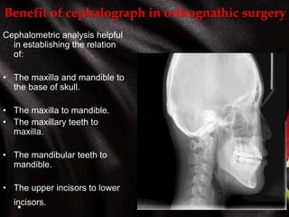 Benefit of cephalograph in orthognathic surgery
Cephalometric analysis helpful
in establishing the relation
of:
• The maxilla and mandible to
the base of skull.
• The maxilla to mandible.
• The maxillary teeth to
maxilla.
• The mandibular teeth to
mandible.
• The upper incisors to lower
incisors.
 