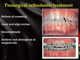Presurgical orthodontic treatment
Relieve of crowding
Level and align arches
Decompensate
Achieve root divergence at
surgical site
 